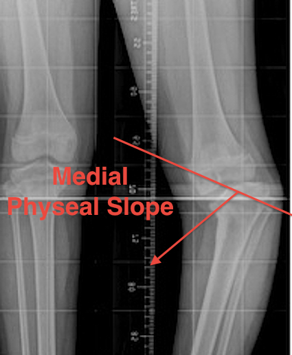 Blounts Medial Physeal Angle